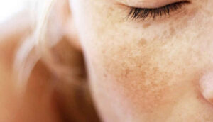 Which Chemical Is Best for Dark Spots?