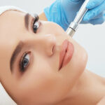 Who is a Good Candidate for Microneedling?