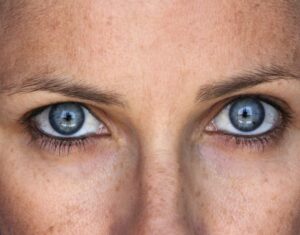 Why Do Age Spots Suddenly Appear?
