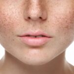 Why Do I Have So Many Age Spots?
