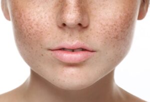 Why Do I Have So Many Age Spots?