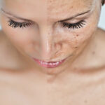 Will a Chemical Peel Remove Dark Spots?