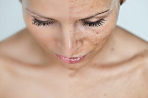 Will a Chemical Peel Remove Dark Spots?